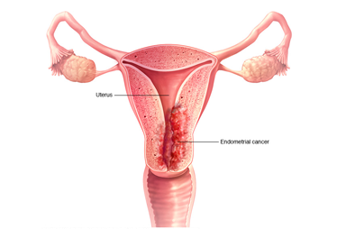 Cancer utérus